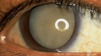 Eye Cataract