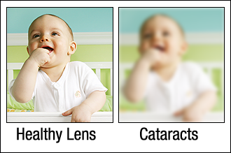 Healthy Lens Cataracts