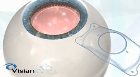 visian icl eye